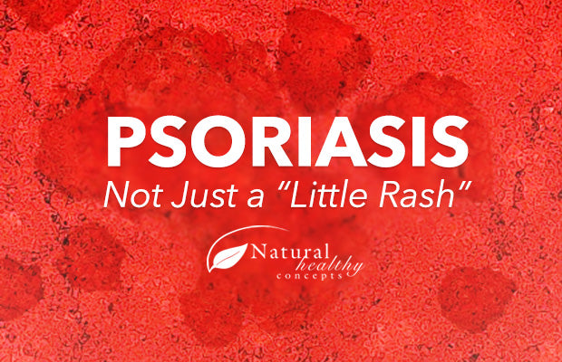 5 Natural Ways to Manage Psoriasis