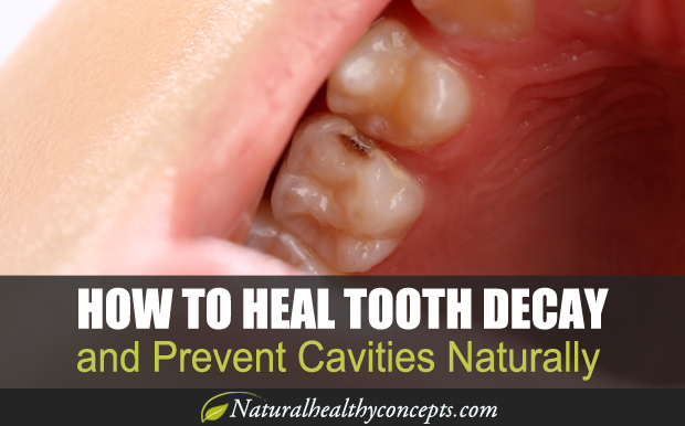 Can Cavities Really Heal On Their Own?