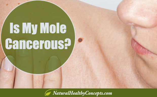 How To Tell If Your Mole Is Cancerous & 7 Natural Ways To Remove Them for Cosmetic Reasons
