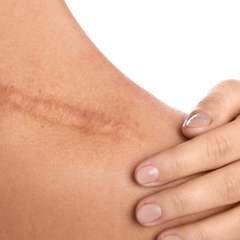 The Role of Vitamin E in Wound Healing and Scarring