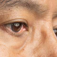 Ask Our Wellness Educators: Dealing With Small Cataracts
